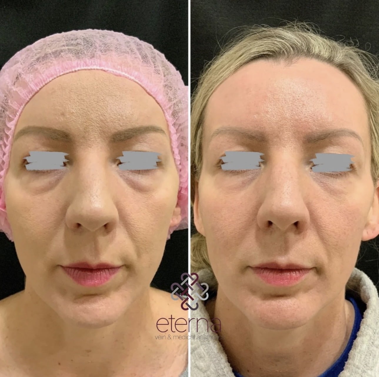 Before and After Image: RF Agnes for Undereye Bags - front