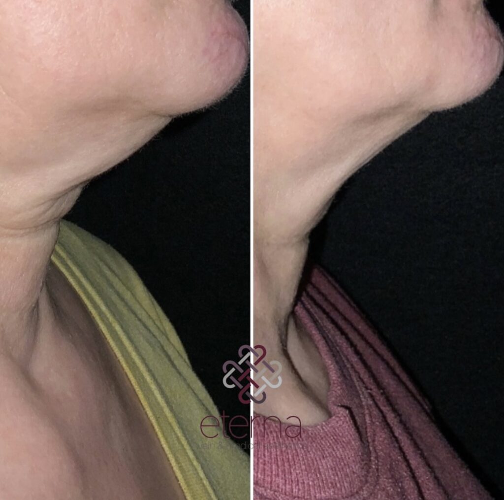 Before and After Image: Scarlet RF Microneedling - right-side