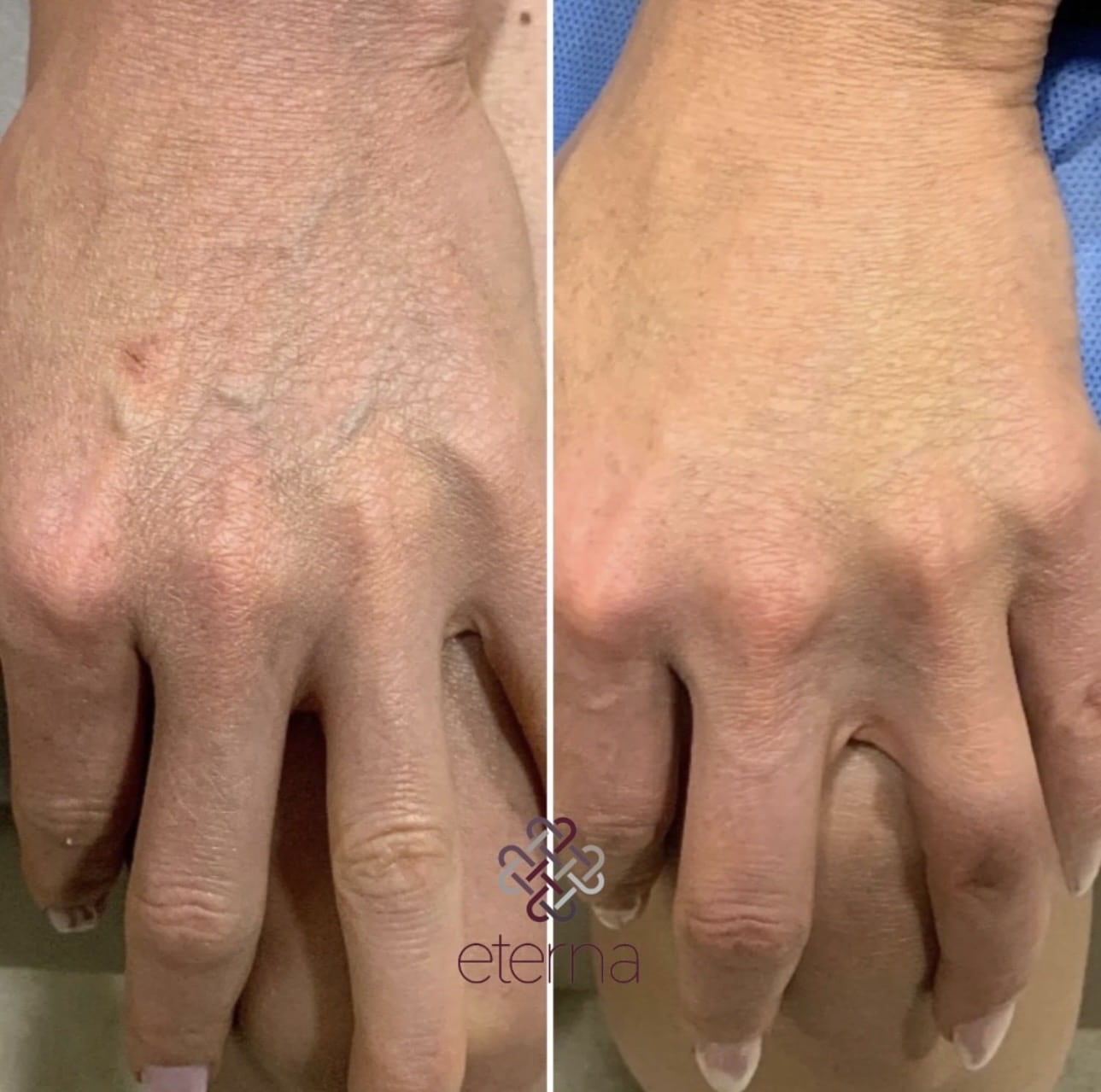 Before and After Image: Sclerotherapy - front