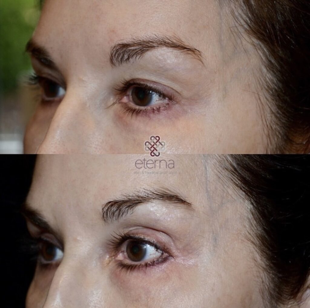 Before and After Image: Upper Eyelid Treated with CO2 - left-front-oblique