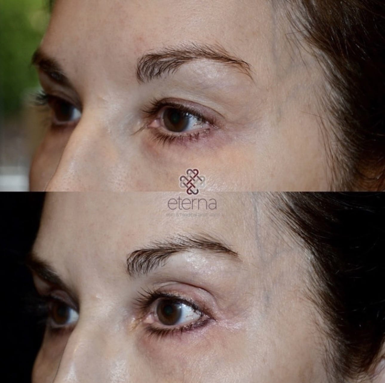Before and After Image: Upper Eyelid Treated with CO2 - left-front-oblique
