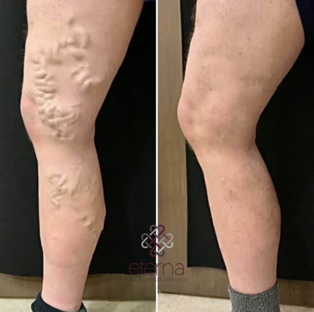 Before and After Image: Vein Ablation + Phlebectomy + Sclerotherapy - left-side