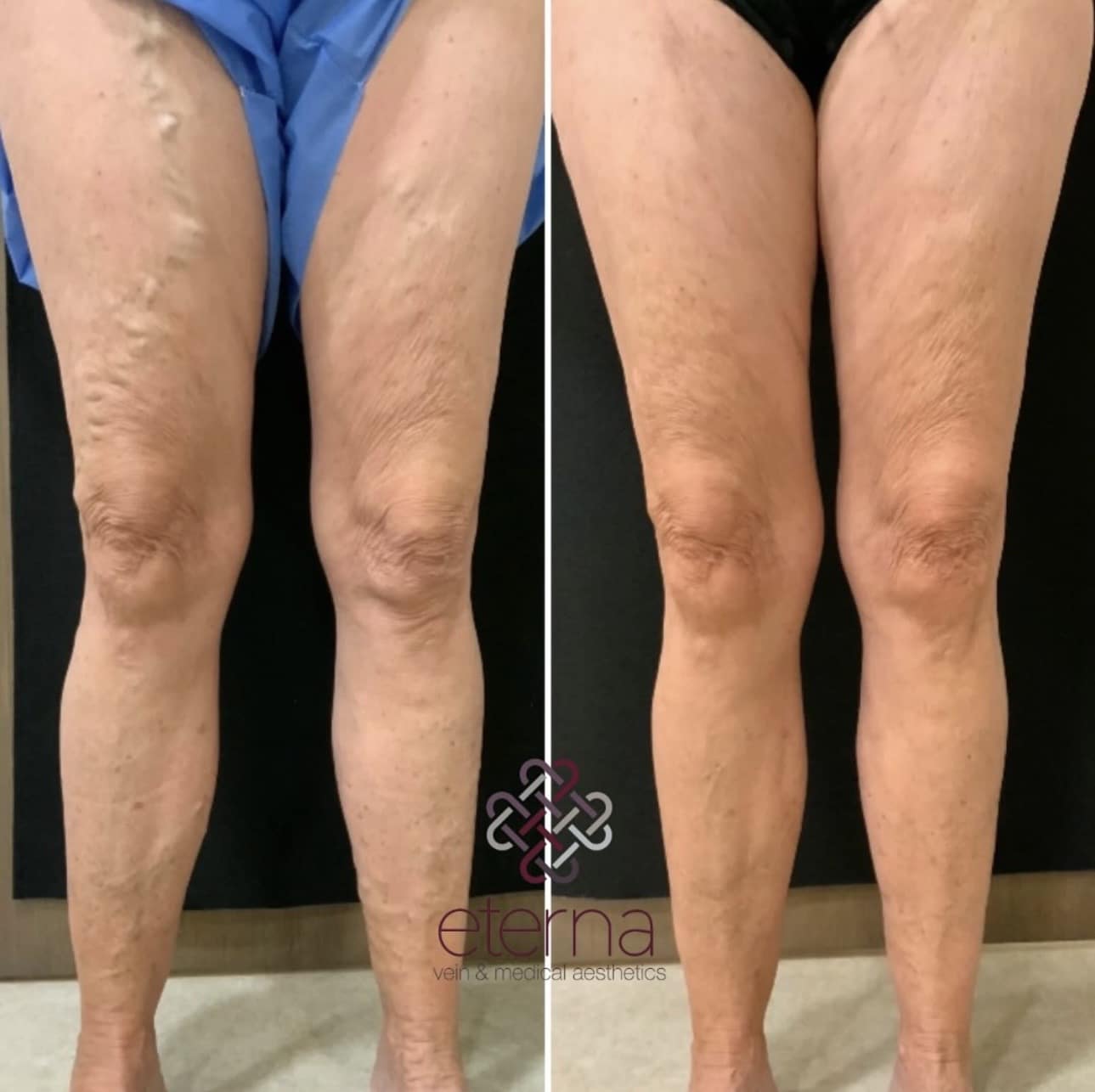 Before and After Image: Vein Ablation + Sclerotherapy - front