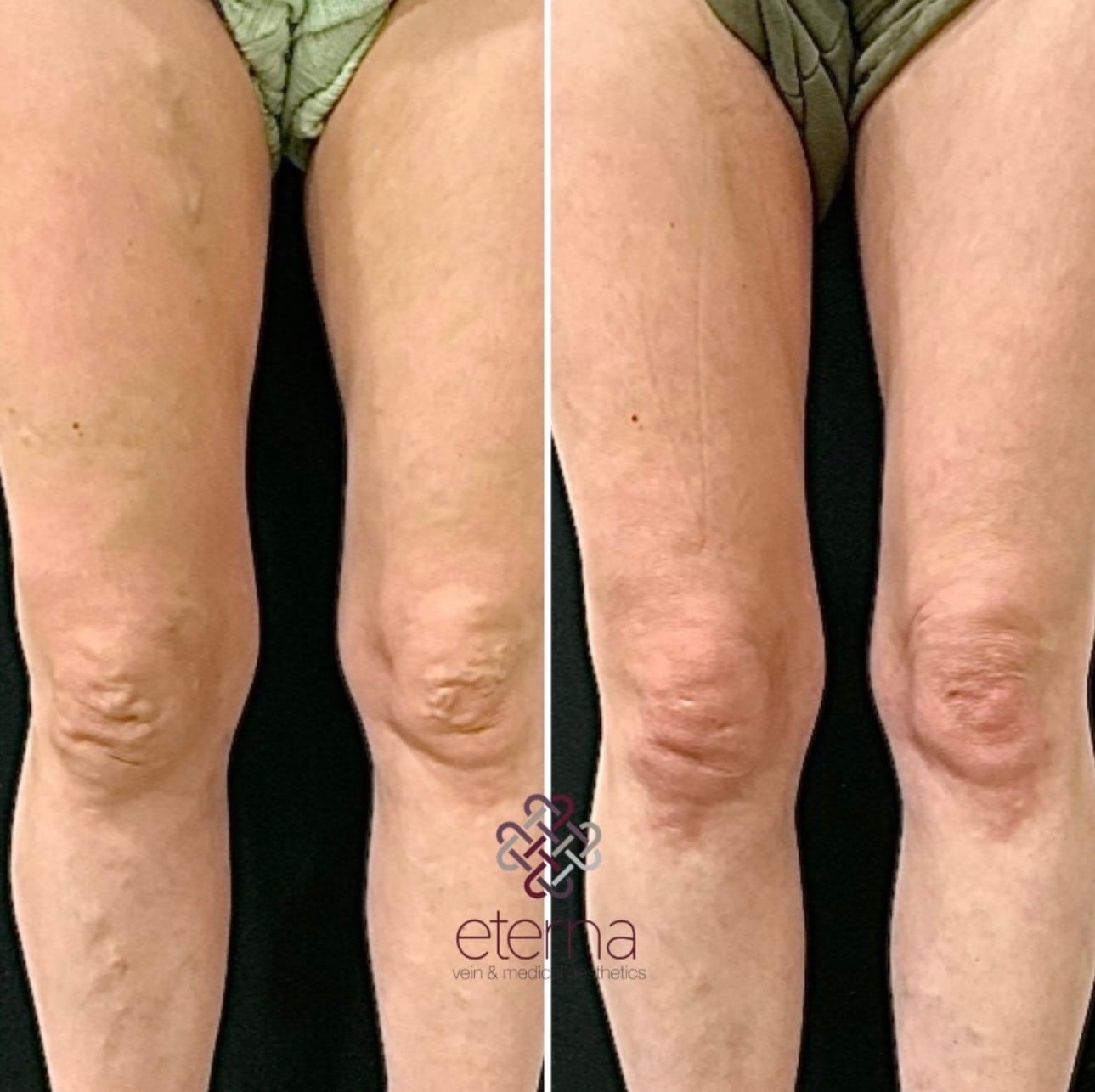 Before and After Image: Vein Ablation + Sclerotherapy - front