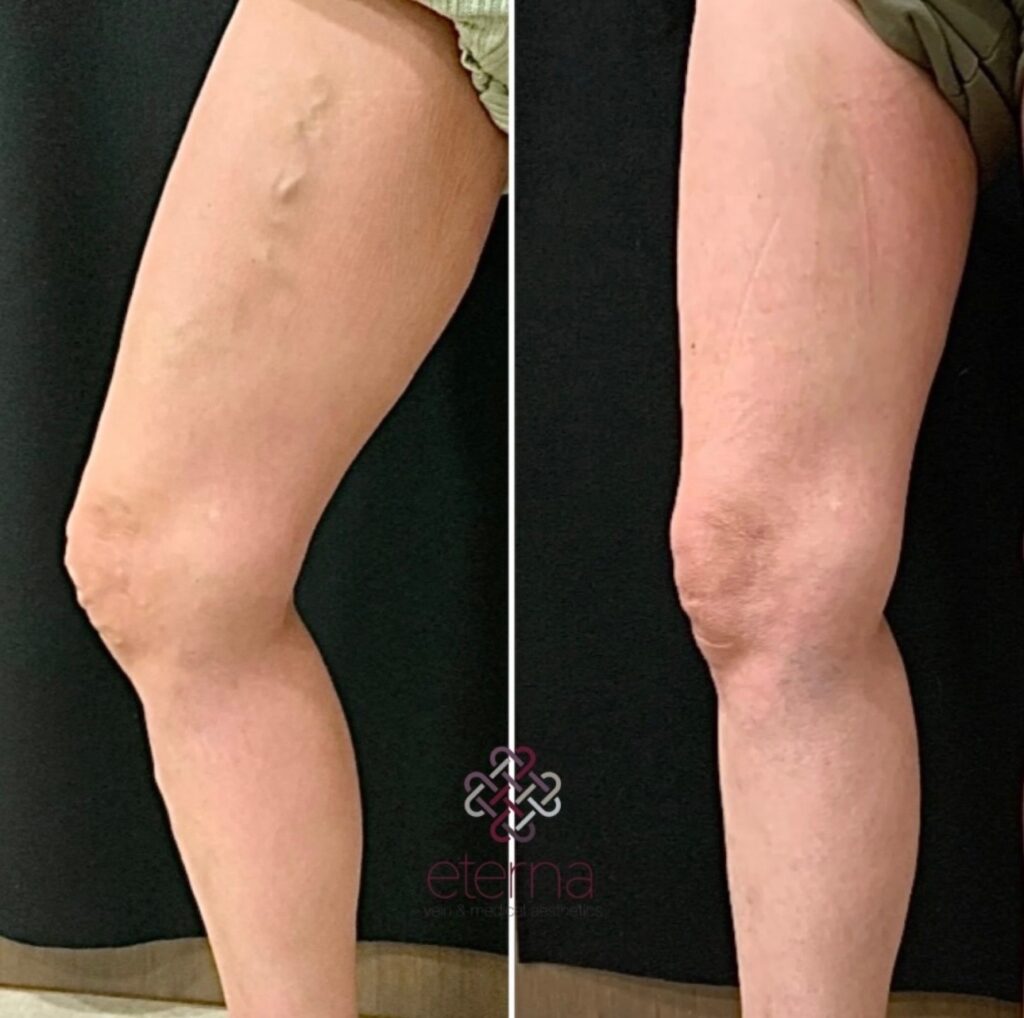 Before and After Image: Vein Ablation + Sclerotherapy - right-side