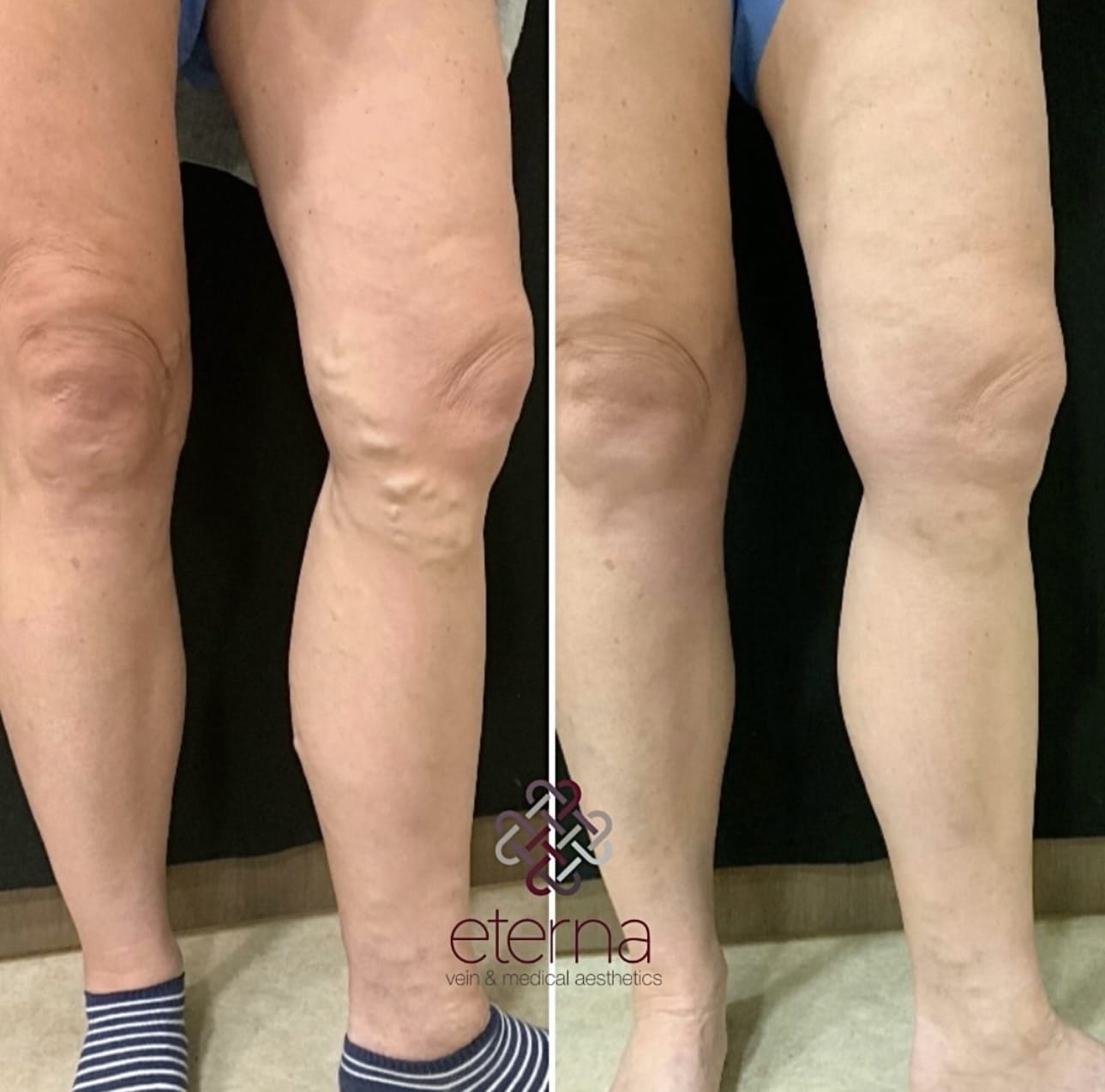 Before and After Image: Ablation + Sclerotherapy - back
