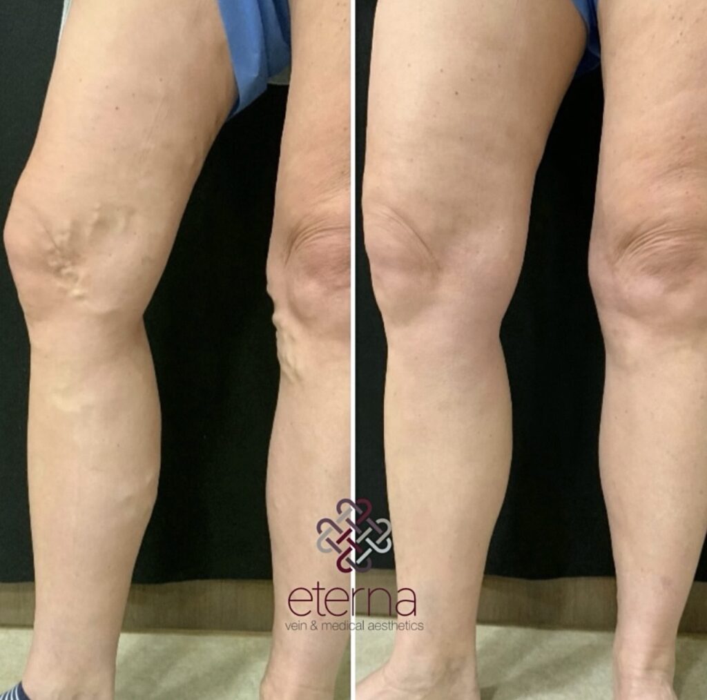 Before and After Image: Ablation + Sclerotherapy - front