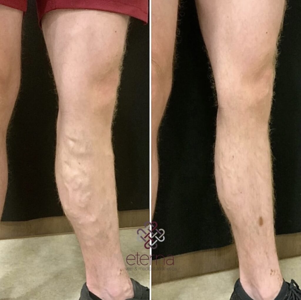 Before and After Image: Ablation + Sclerotherapy - left-side