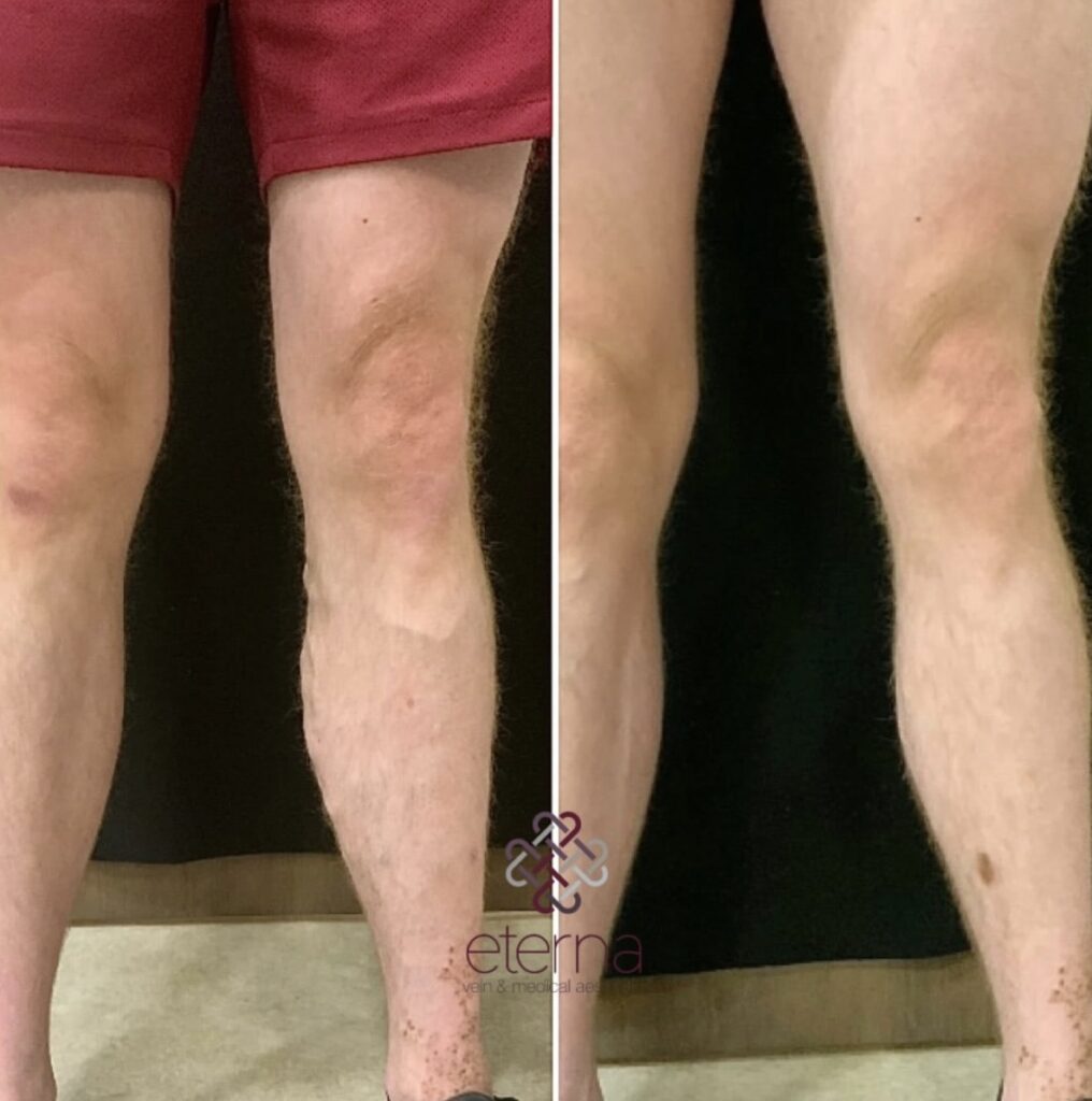 Before and After Image: Ablation + Sclerotherapy - front