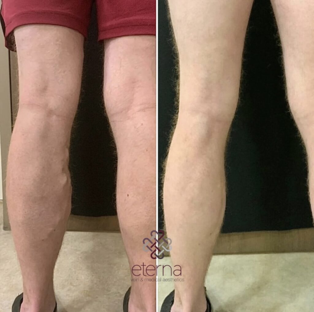 Before and After Image: Ablation + Sclerotherapy - back