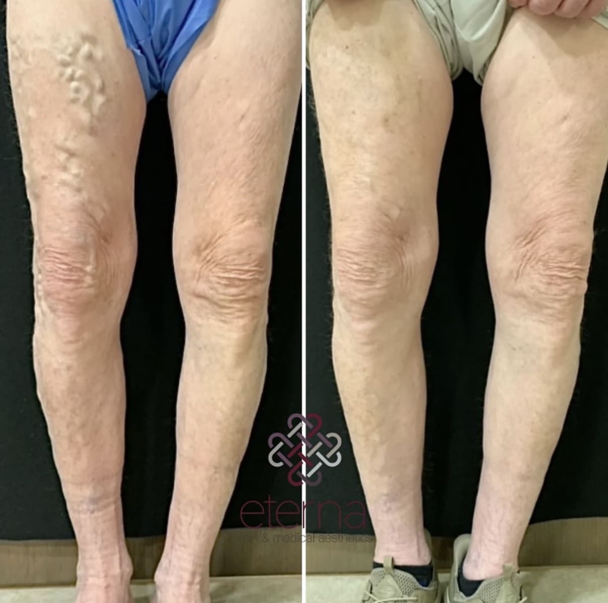 Before and After Image: Ablation + Sclerotherapy - front