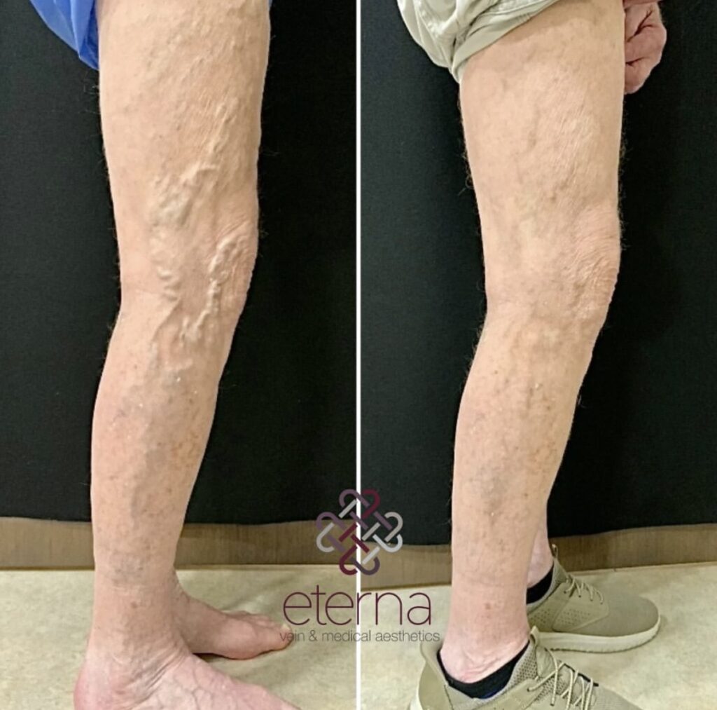 Before and After Image: Ablation + Sclerotherapy - right-side