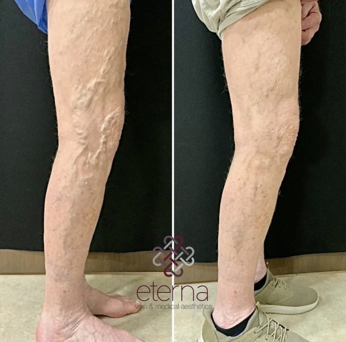 Before and After Image: Ablation + Sclerotherapy - right-side
