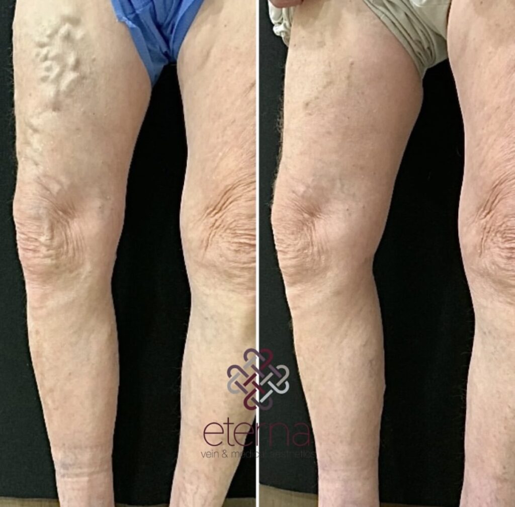 Before and After Image: Ablation + Sclerotherapy - front