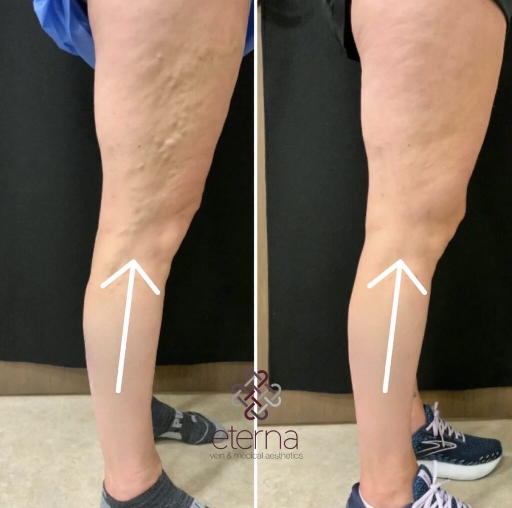 Before and After Image: Ablation + Sclerotherapy - back