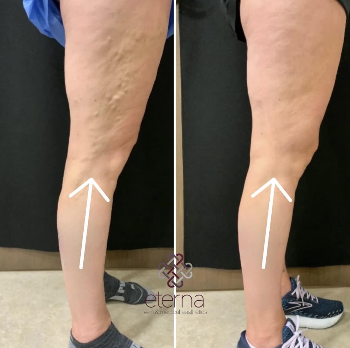 Before and After Image: Ablation + Sclerotherapy - back