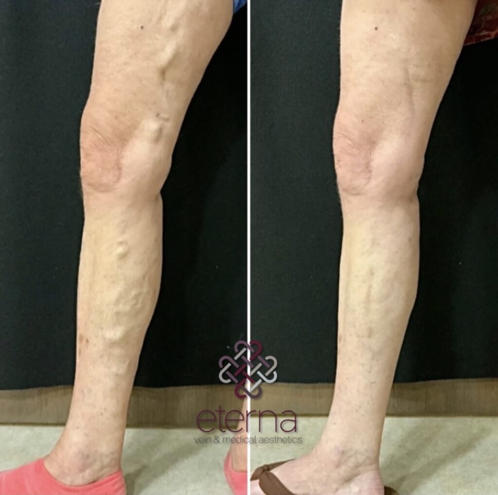 Before and After Image: Vein Ablation + Sclerotherapy - left-side