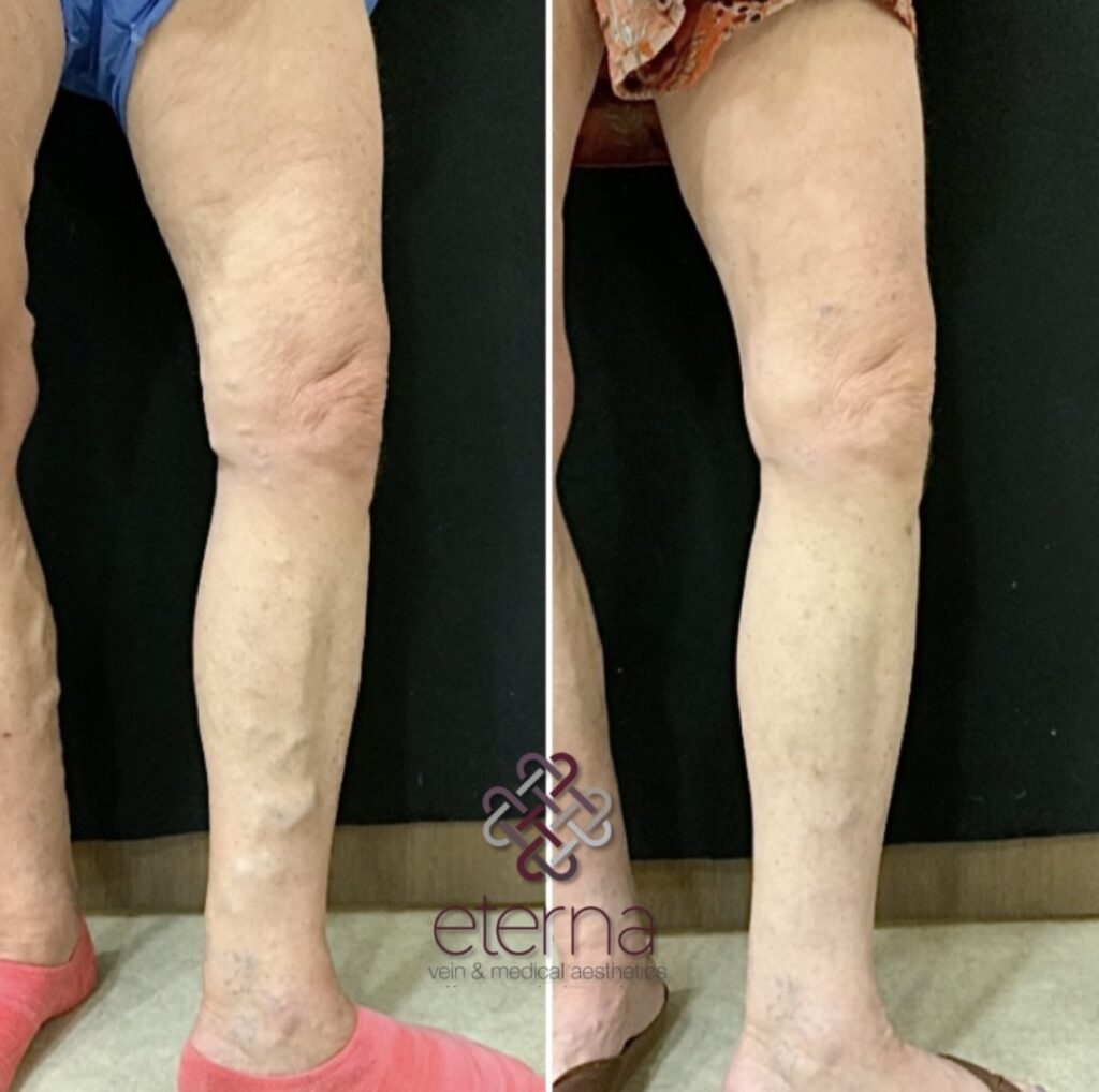 Before and After Image: Vein Ablation + Sclerotherapy - right-front-oblique