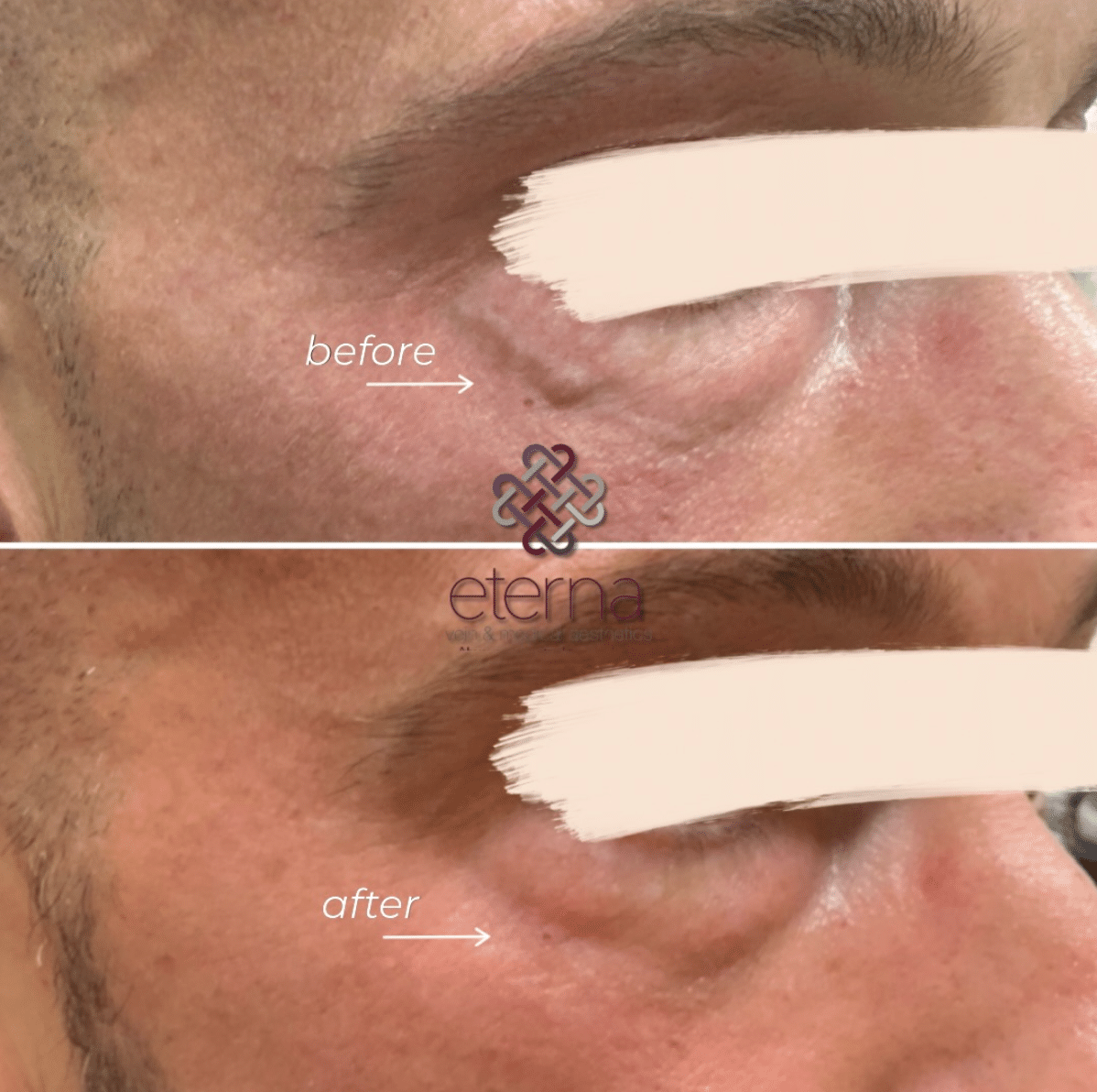Before and After Image: Excel V+ - front
