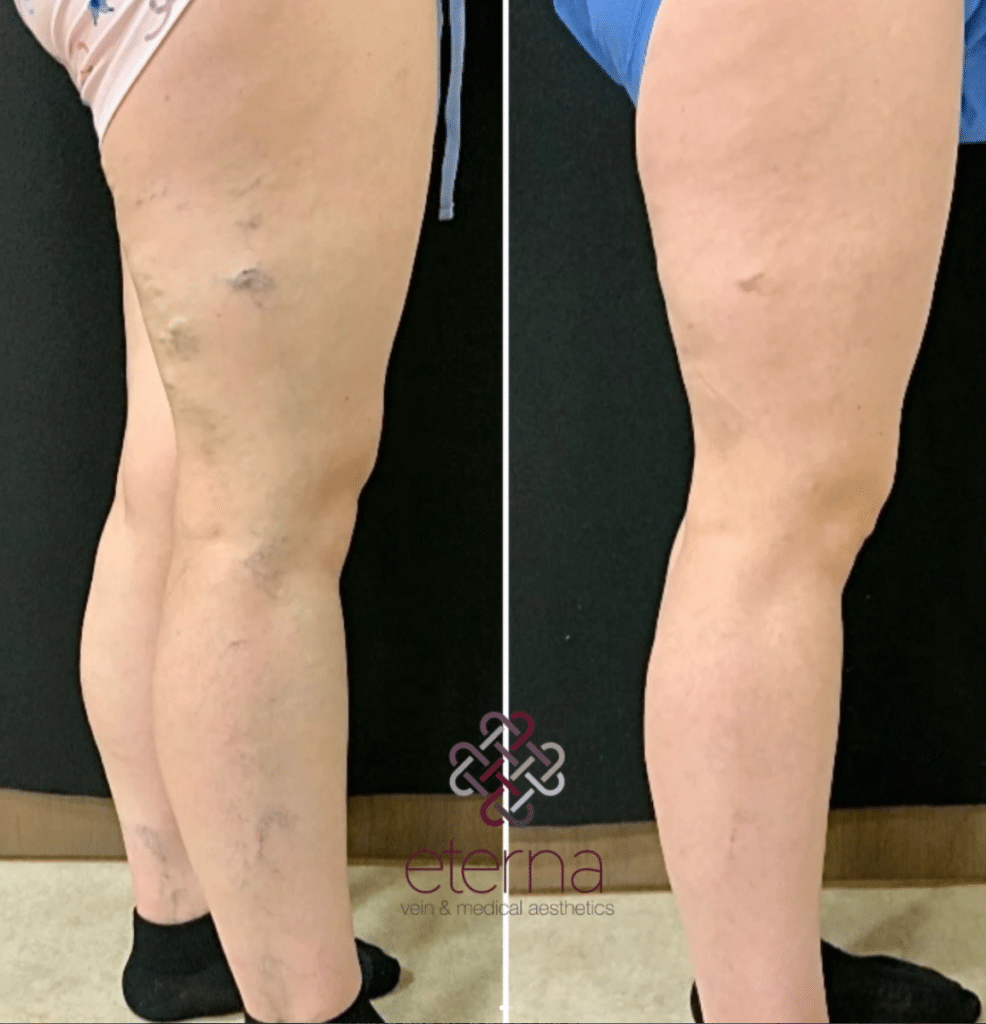Before and After Image: Sclerotherapy - right-side