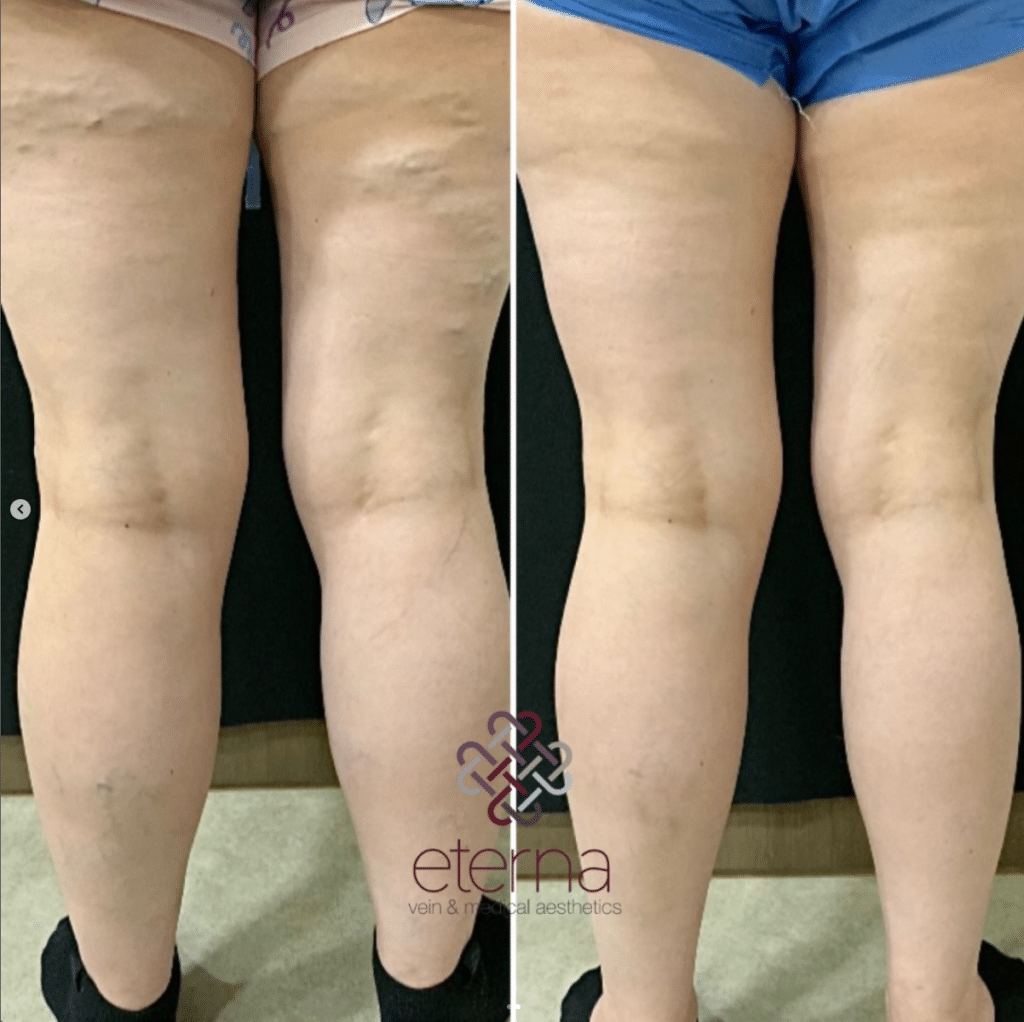 Before and After Image: Sclerotherapy - left-back-oblique