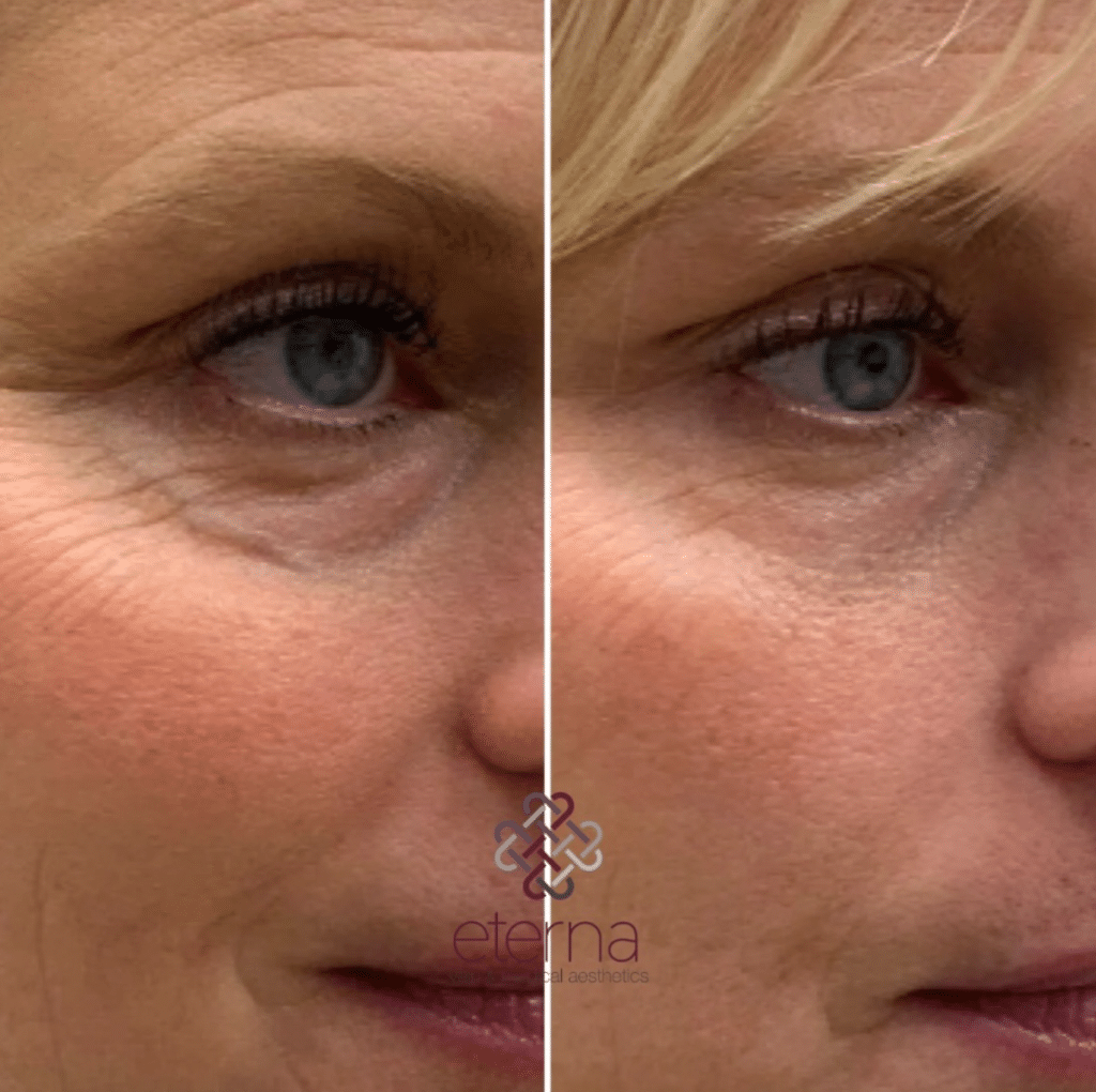 Before and After Image: Vein Treatment - front