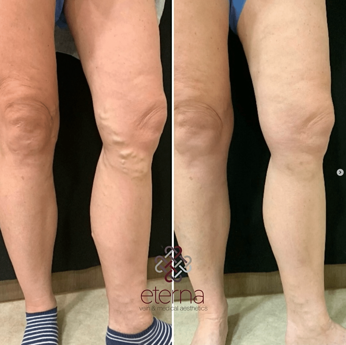 Before and After Image: Vein Treatment - front