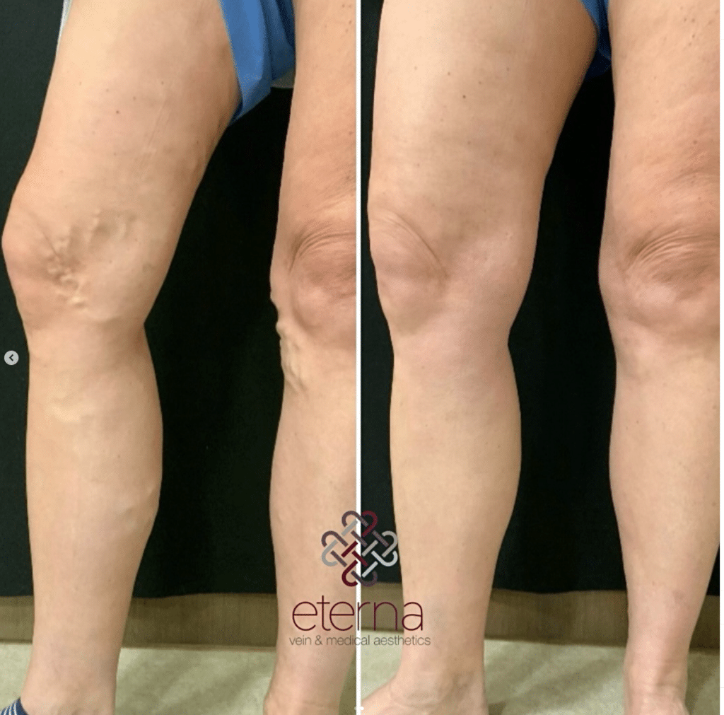 Before and After Image: Vein Treatment - front