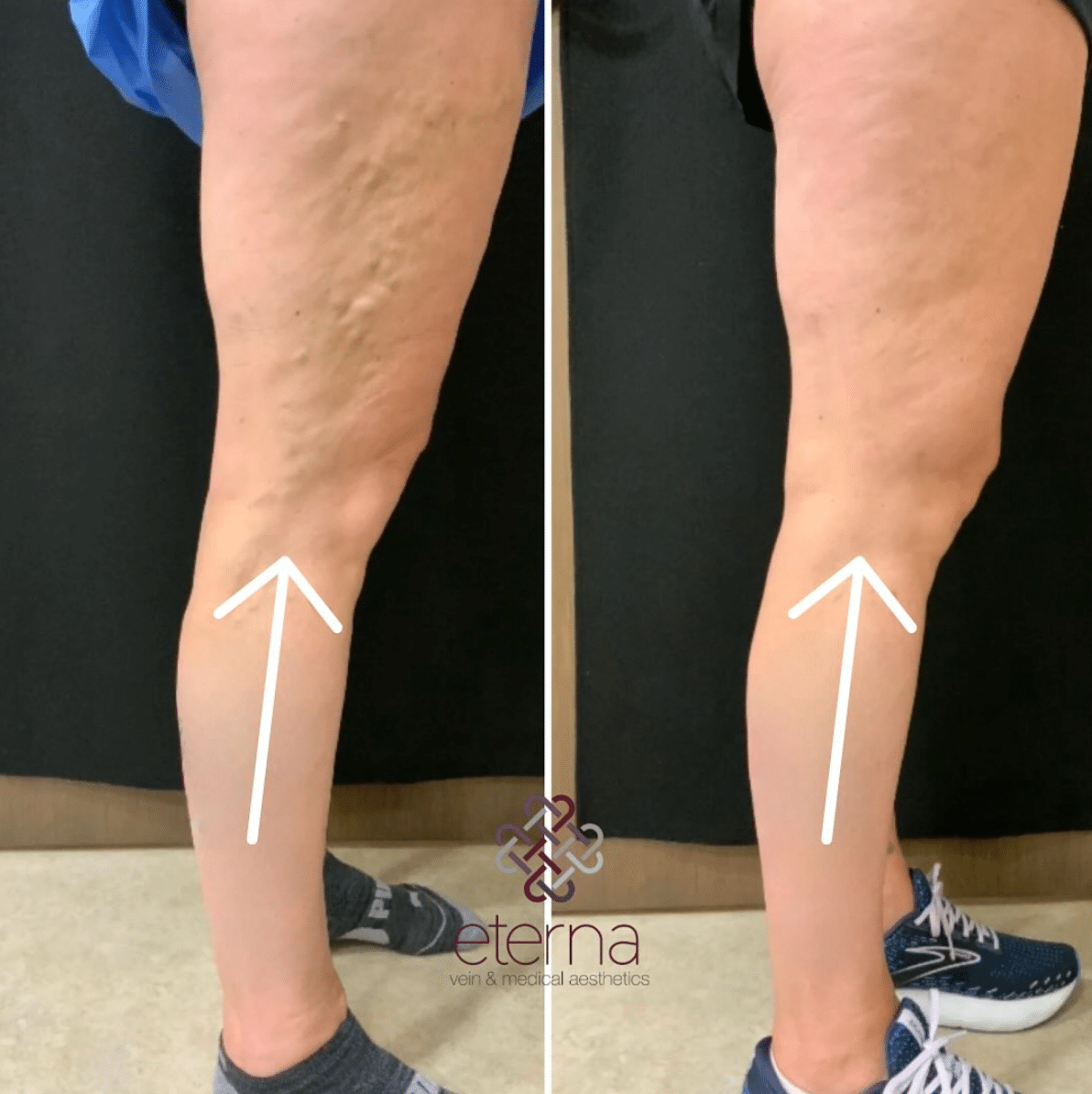 Before and After Image: Vein Treatment - front